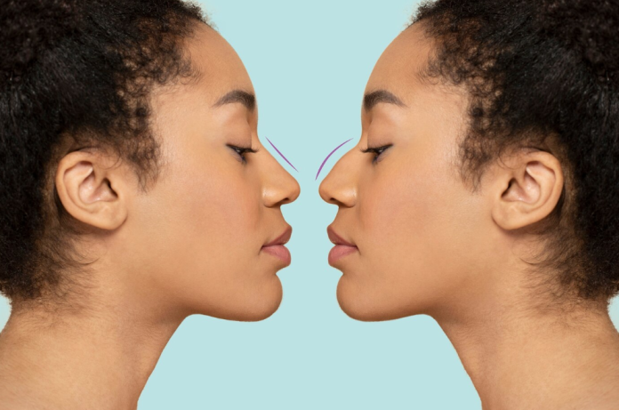 imagem ilustrativa de antes e depois rinoplastia