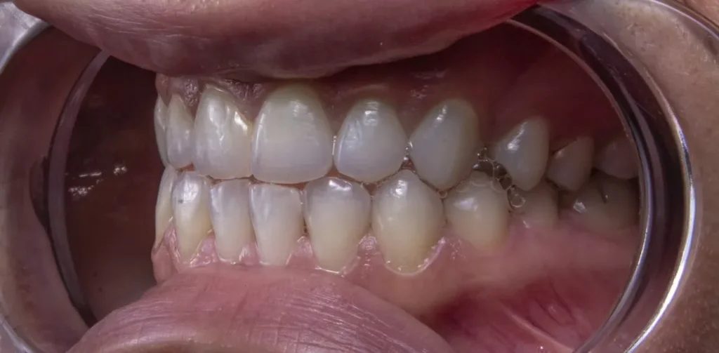 Lente de contato dental: tire todas suas dúvidas sobre o assunto. | Foto: Unsplash.