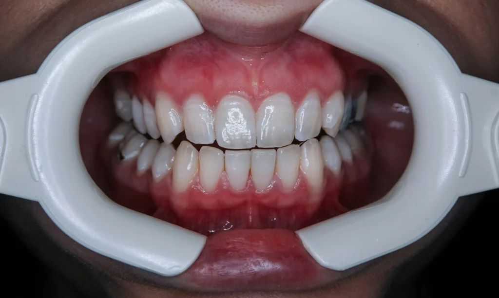 como-funciona-o-clareamento-dental-caseiro